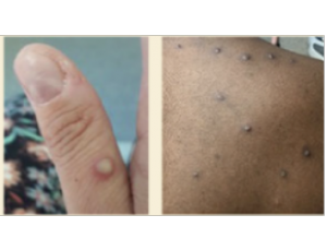 Two examples of Monkeypox rashes. The left example shows a thumb with one lesion, a pus filled sore. The right example shows a person’s back with multiple bumpy lesions that may or may not have fluid.